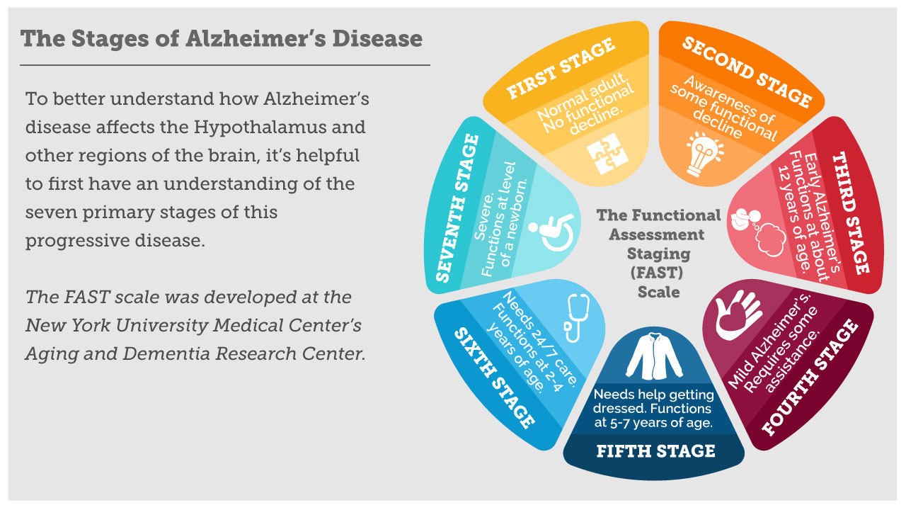 Alzheimer’s disease What we know and what we can expect from the